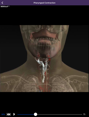 Animation of impairment of pharyngeal contraction.